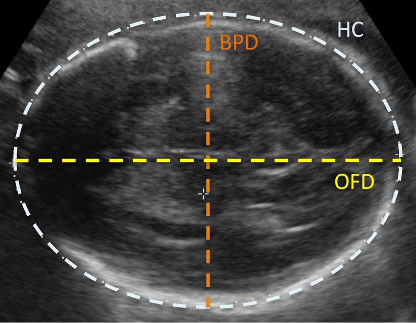 bpd در سونوگرافی بارداری چیست؟