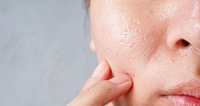 لیزر co2 فرکشنال برای منافذ باز پوست