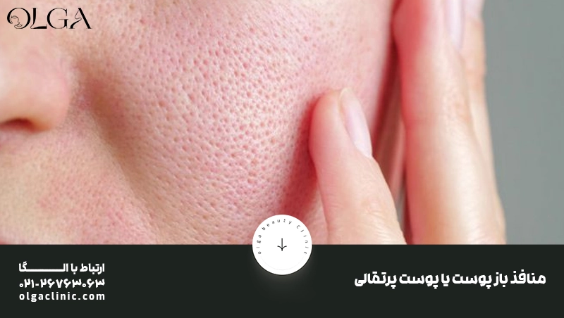پوست لیزر co2 فرکشنال برای منافذ باز پوست