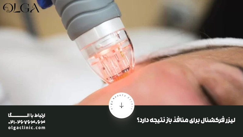 پوست لیزر فرکشنال برای منافذ باز نتیجه دارد؟
